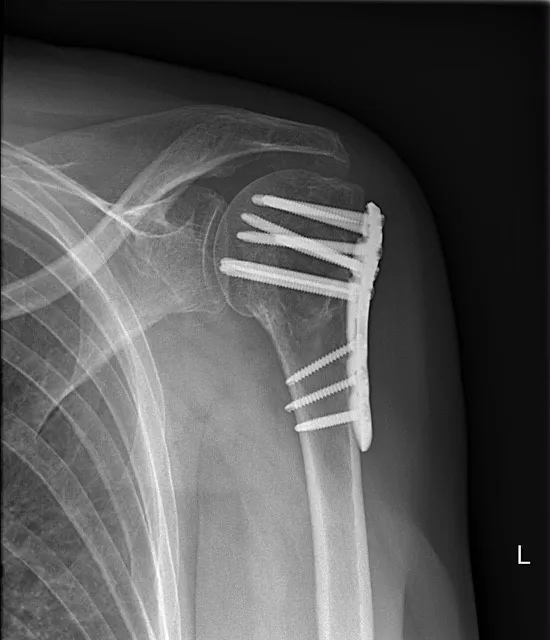 Schouderbreuk: operatieve behandeling op rontgenbeeld - Orthopedie Turnhout.