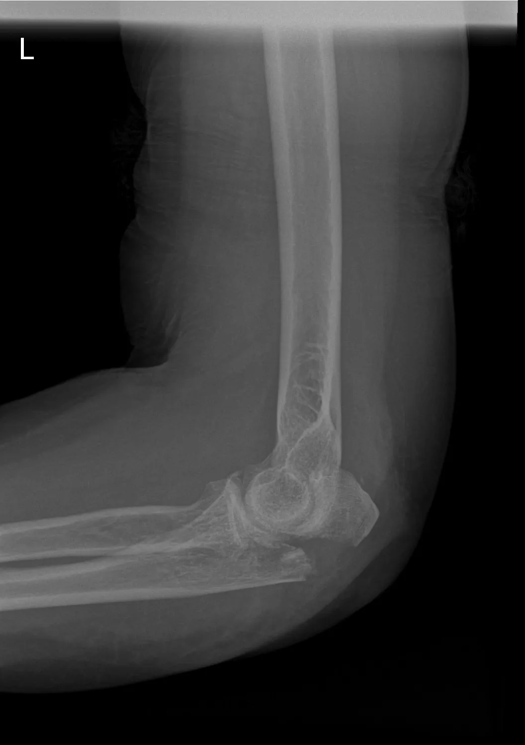 Olecranonbreuk: medisch beeld bij Orthopedie Turnhout.