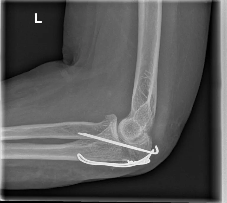 Olecranonbreuk: cerclage-fixatie op rontgenbeeld - Orthopedie Turnhout.