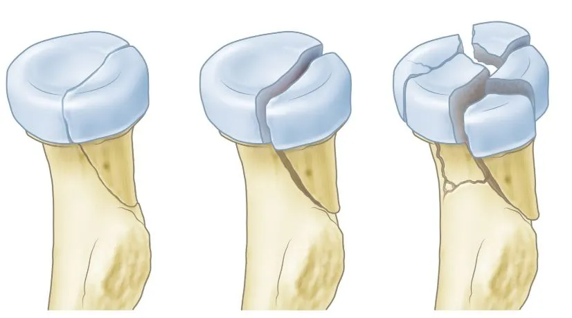 Radiuskopbreuk: medisch beeld bij Orthopedie Turnhout.