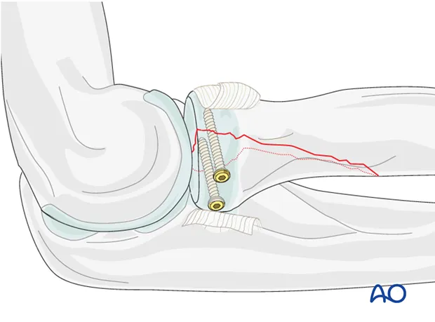 Radiuskopbreuk: fixatie met schroef op rontgenbeeld - Orthopedie Turnhout.