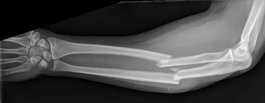 Onderarmbreuk: medisch beeld bij Orthopedie Turnhout.