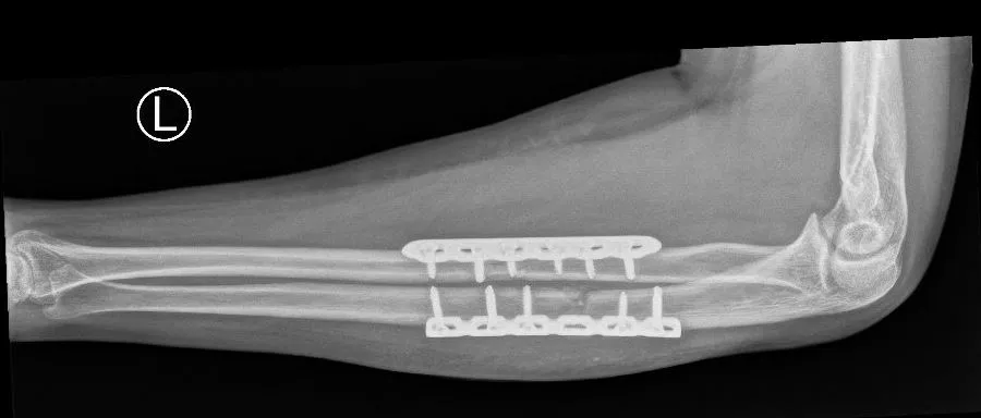 Onderarmbreuk: operatie met plaat en schroeven op rontgenbeeld - Orthopedie Turnhout.