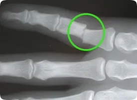 Anatomische tekening van een vingerbreuk met breuklijn in het kootje van de vinger