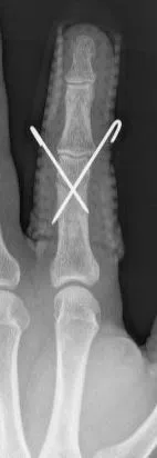 Pinning bij vingerbreuk waarbij de fractuur gestabiliseerd wordt met K-draden