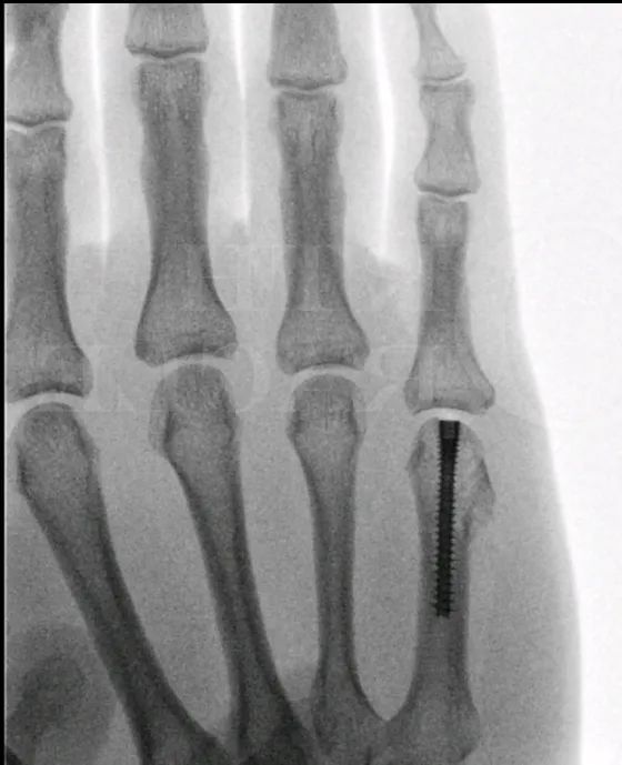 Boksersfractuur gefixeerd met schroef na osteosynthese van het middenhandbeentje