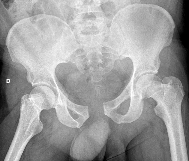Bekkenbreuk: open book-type op rontgenbeeld - Orthopedie Turnhout.