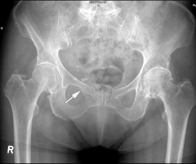 Bekkenbreuk: stabiele schaambeenfractuur op rontgenbeeld - Orthopedie Turnhout.