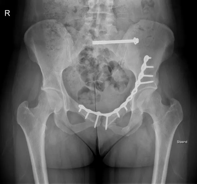 Bekkenbreuk: operatie met plaat en schroeven op rontgenbeeld - Orthopedie Turnhout.