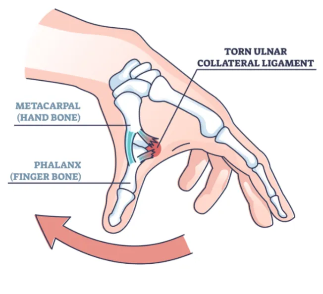 Anatomie van skiduim met scheur van het ulnair collateraal ligament aan de duim