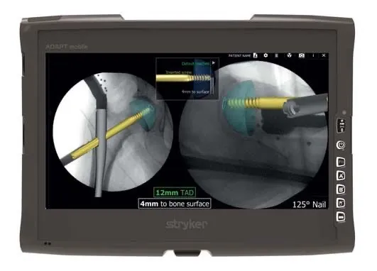 Heupfractuur: fixatie met mergpen op rontgenbeeld - Orthopedie Turnhout.