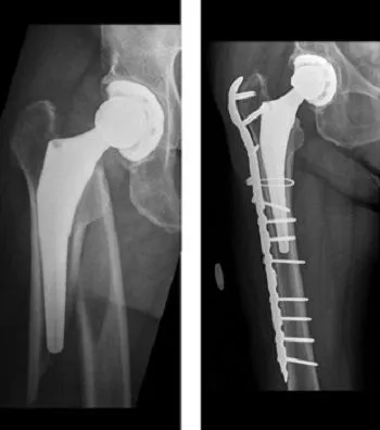 Breuk rond heupprothese: medisch beeld bij Orthopedie Turnhout.