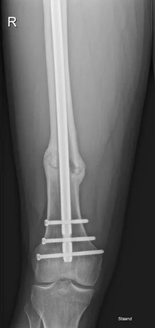 Dijbeenbreuk: fixatie met mergpen op rontgenbeeld - Orthopedie Turnhout.