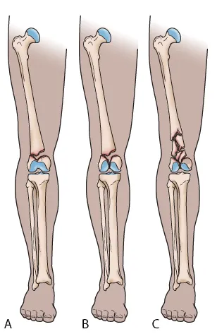 Kniebreuk (boven knie): medisch beeld bij Orthopedie Turnhout.