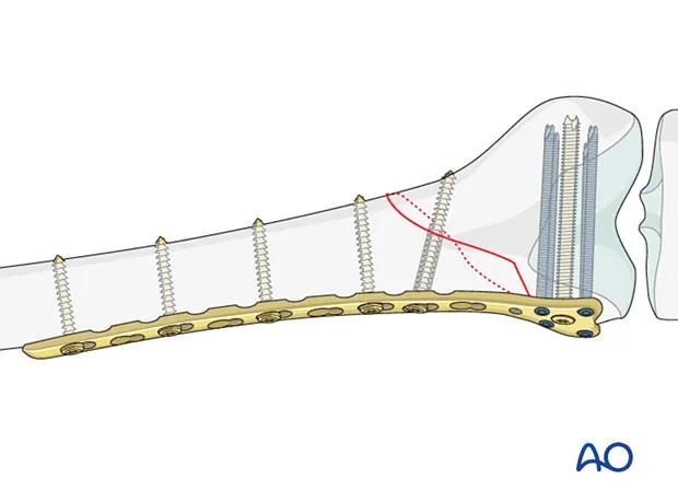 Kniebreuk (boven knie): fixatie met plaat op rontgenbeeld - Orthopedie Turnhout.
