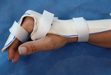 Postoperatief beeld na peesletsel-herstel van de hand met spalk voor revalidatie