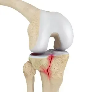 Scheenbeenkopbreuk: medisch beeld bij Orthopedie Turnhout.