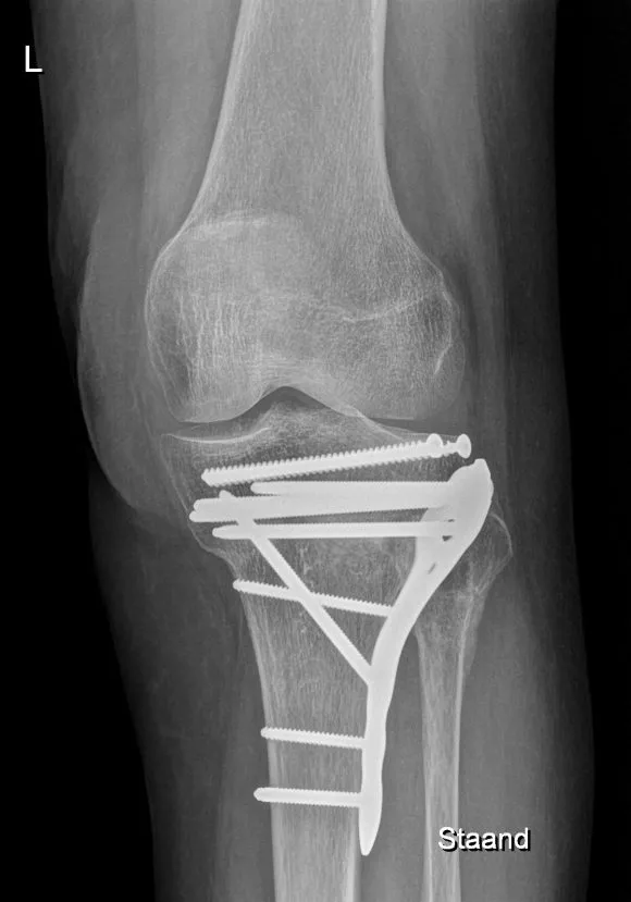 Scheenbeenkopbreuk: operatie met plaat en schroeven op rontgenbeeld - Orthopedie Turnhout.