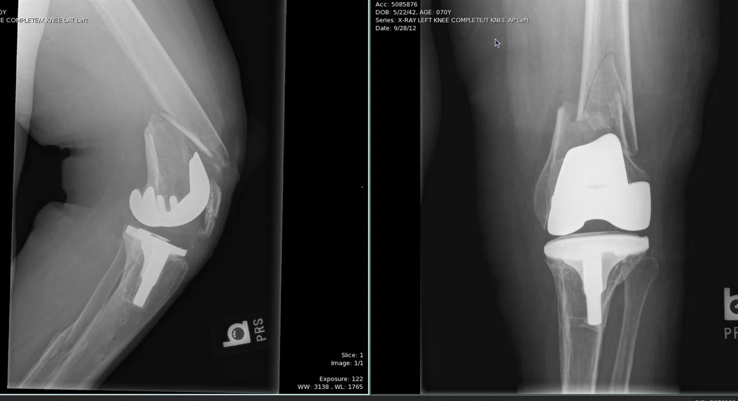 Breuk rond knieprothese: medisch beeld bij Orthopedie Turnhout.