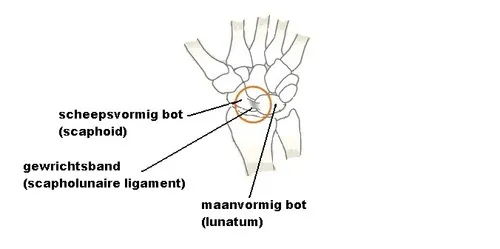Anatomie van scapholunaire ligamentruptuur tussen scaphoid en lunatum in de pols