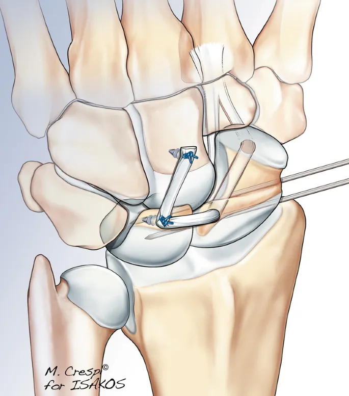 Modified Brunelli techniek voor reconstructie van scapholunaire ligament met peestransfer