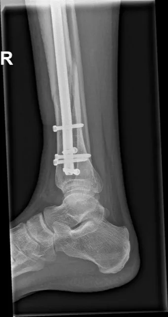 Onderbeenbreuk: fixatie met mergpen op rontgenbeeld - Orthopedie Turnhout.