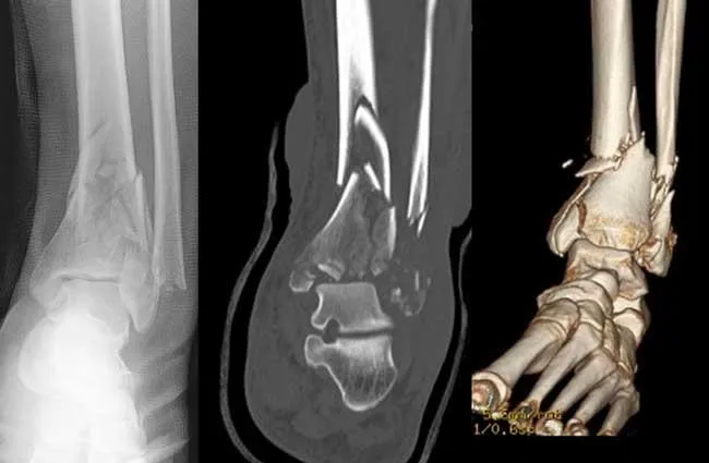 Pilonfractuur: medisch beeld bij Orthopedie Turnhout.
