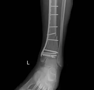 Pilonfractuur: ORIF (open repositie en interne fixatie) op rontgenbeeld - Orthopedie Turnhout.