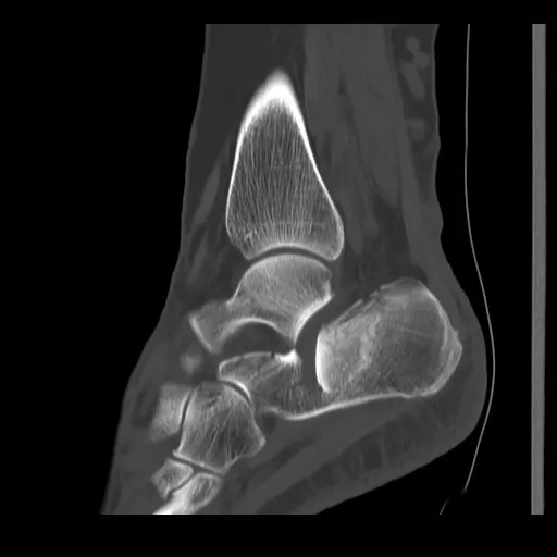 Calcaneusbreuk / gebroken hiel: medisch beeld bij Orthopedie Turnhout.