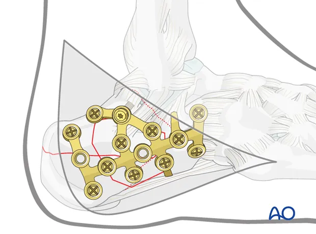 Calcaneusbreuk / gebroken hiel: fixatie met plaat op rontgenbeeld - Orthopedie Turnhout.