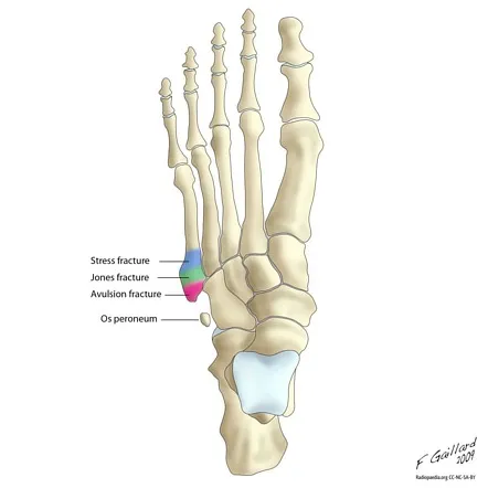 Jones-fractuur: medisch beeld bij Orthopedie Turnhout.