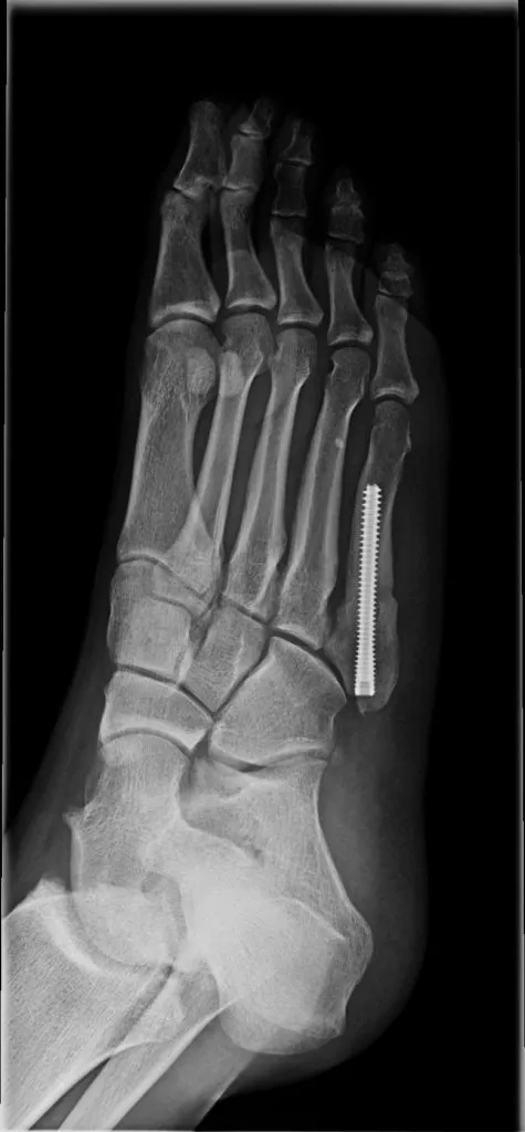 Jones-fractuur: fixatie met schroef op rontgenbeeld - Orthopedie Turnhout.