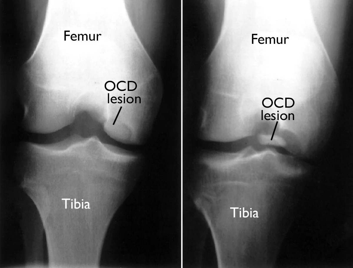 Twee röntgenbeelden met aanduiding van een osteochondritis-dissecansletsel aan de femurcondyl