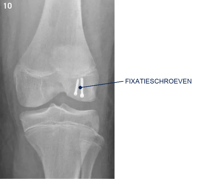 Röntgenfoto van de knie met aangeduide fixatiepennetjes in de femurcondyl