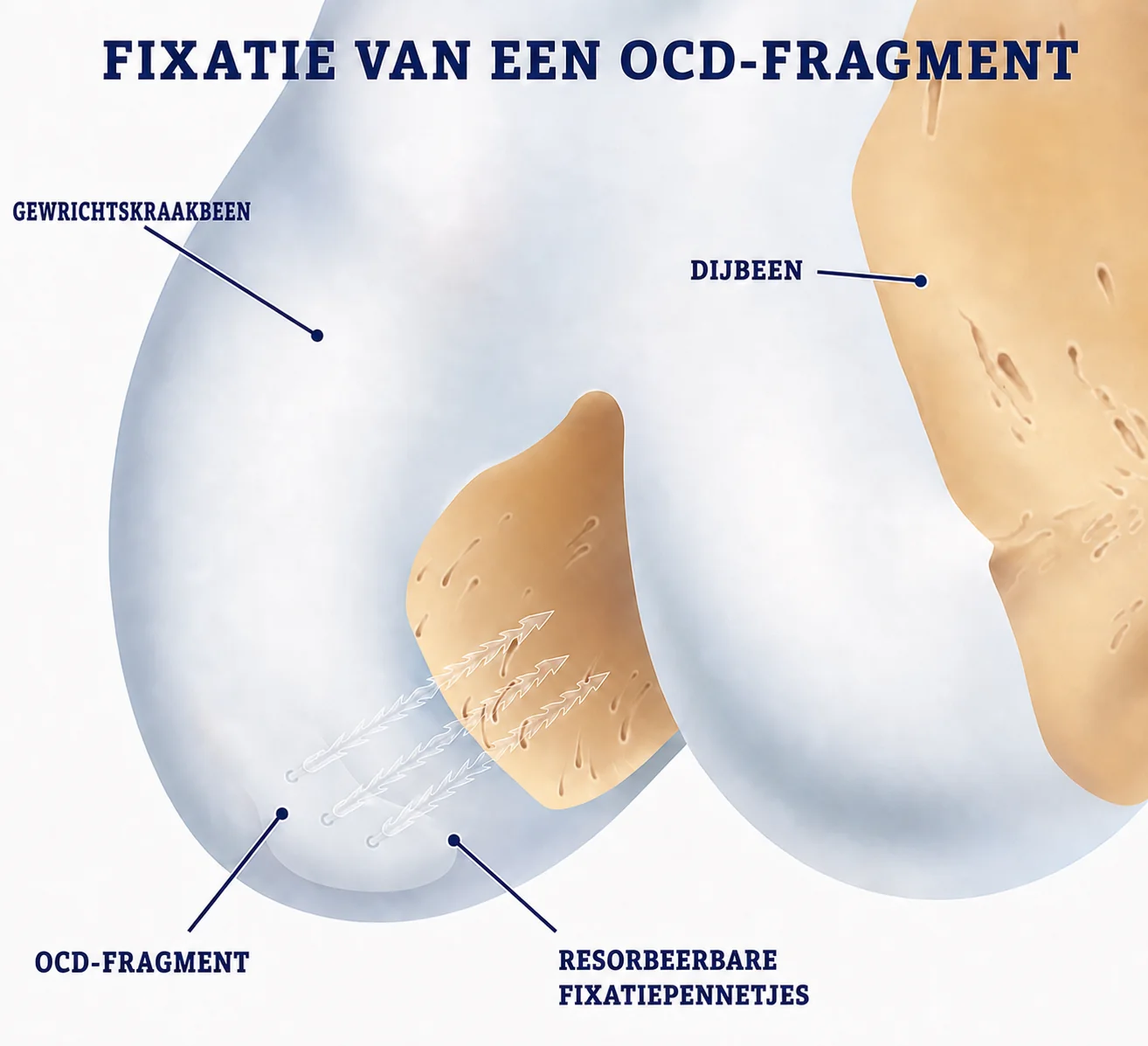 Illustratie van fixatie van een kraakbeen-botfragment in de femurcondyl met resorbeerbare pennetjes