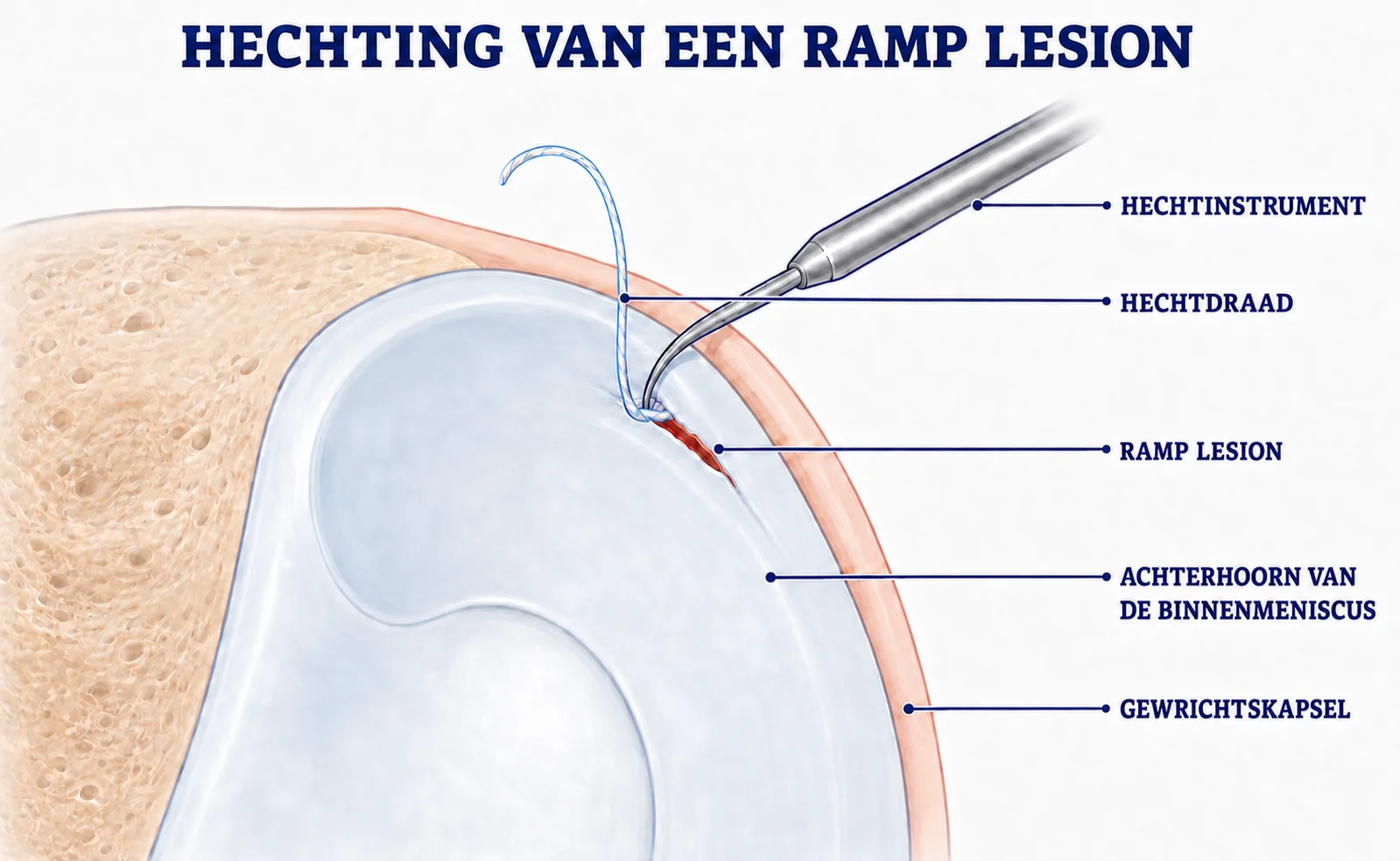 Stappen van een kijkoperatie waarbij een rampscheur van de binnenmeniscus wordt gehecht