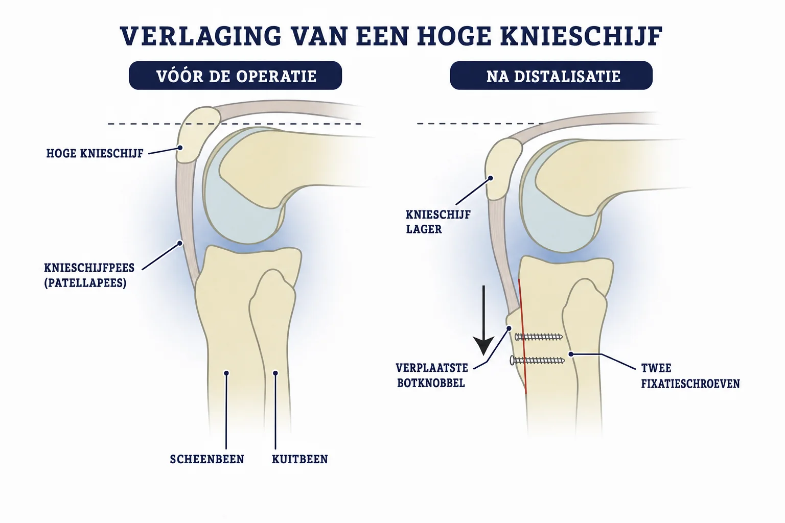 Vergelijking voor en na een operatie waarbij een hoge knieschijf wordt verlaagd