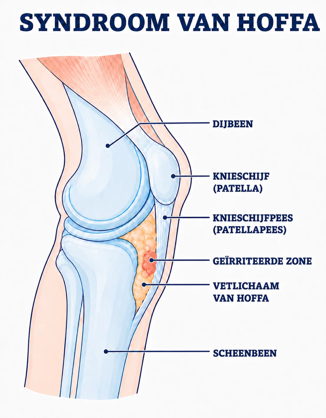 Anatomische illustratie van het geïrriteerde vetlichaam van Hoffa onder de knieschijf