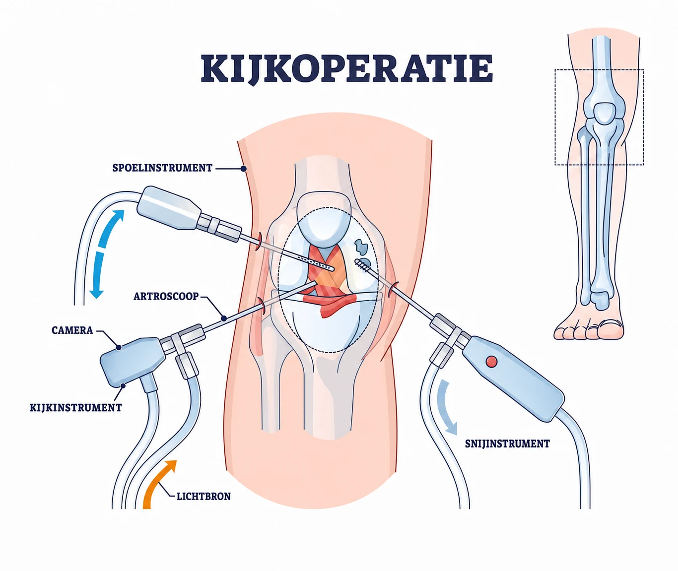 Kijkoperatie van de knie met camera, spoelinstrument en snijinstrument via kleine sneetjes