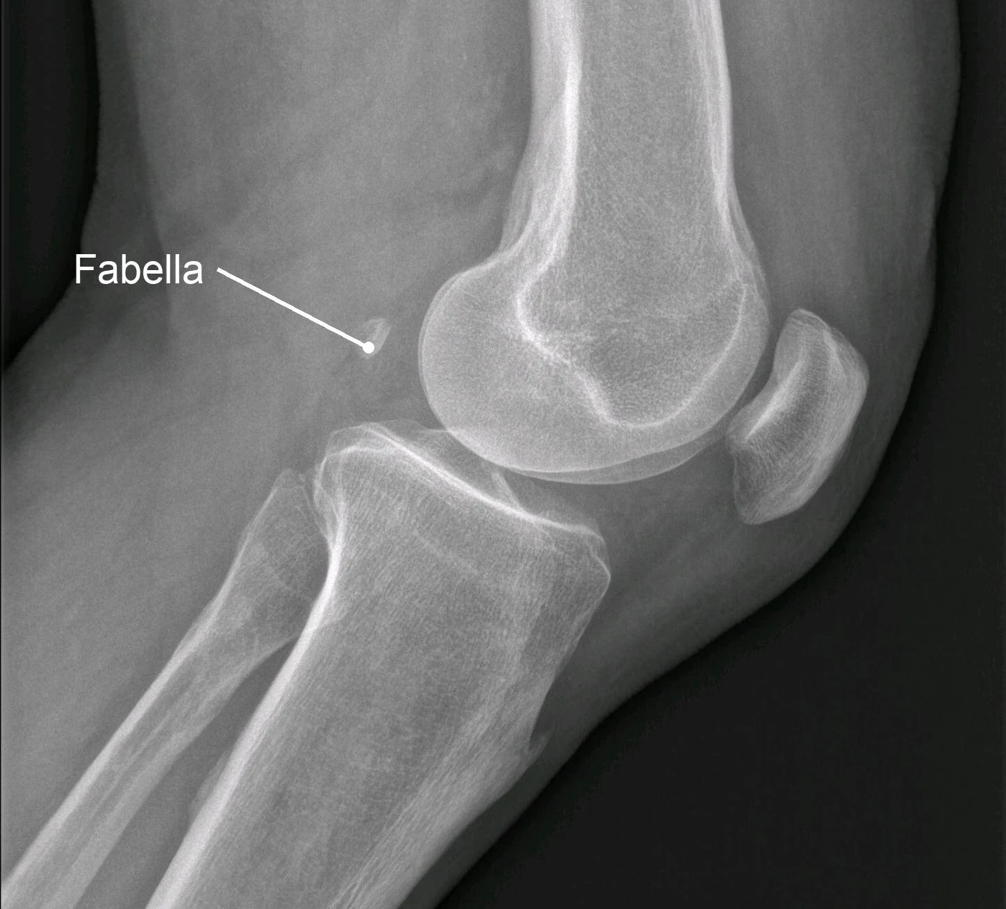Röntgenfoto van de knie in zijaanzicht met de fabella zichtbaar achter de dijbeencondyl