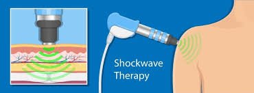Shockwave-therapie op de schouder om de kalk in de pees af te breken