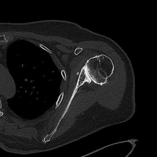 CT-scan van een versleten schouder voor de planning van een prothese