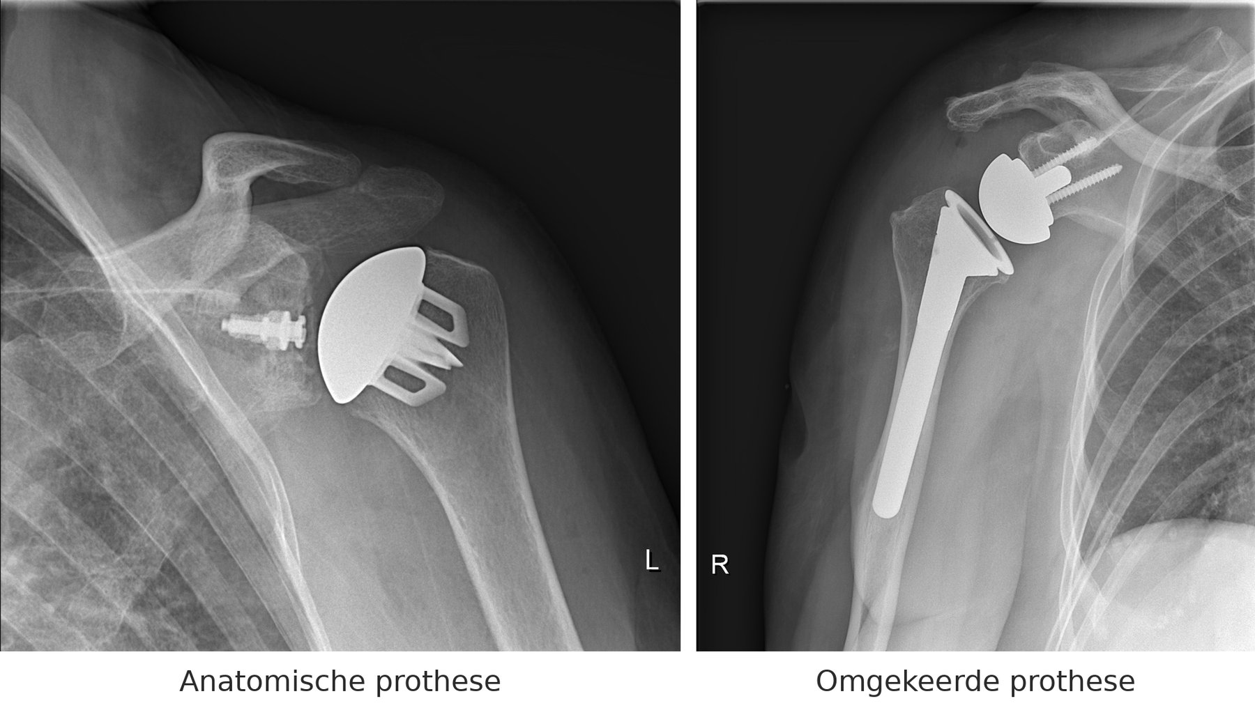 Röntgenfoto van een anatomische en een omgekeerde schouderprothese naast elkaar