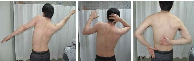 Beperkte beweging van de arm bij een frozen shoulder, vergeleken met een gezonde schouder