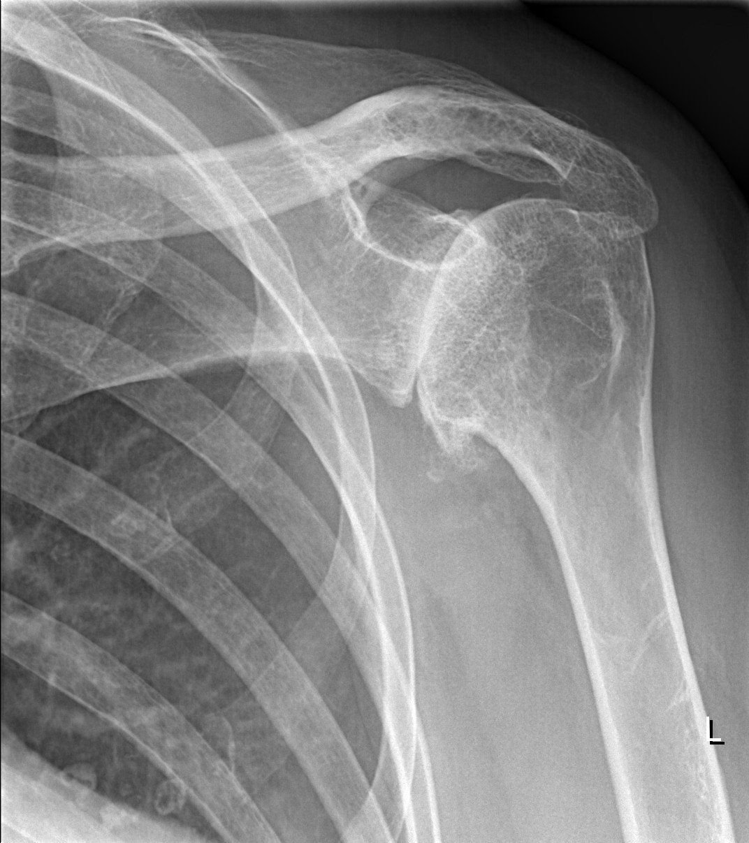 Röntgenfoto van een schouder met artrose en een versmalde gewrichtsspleet