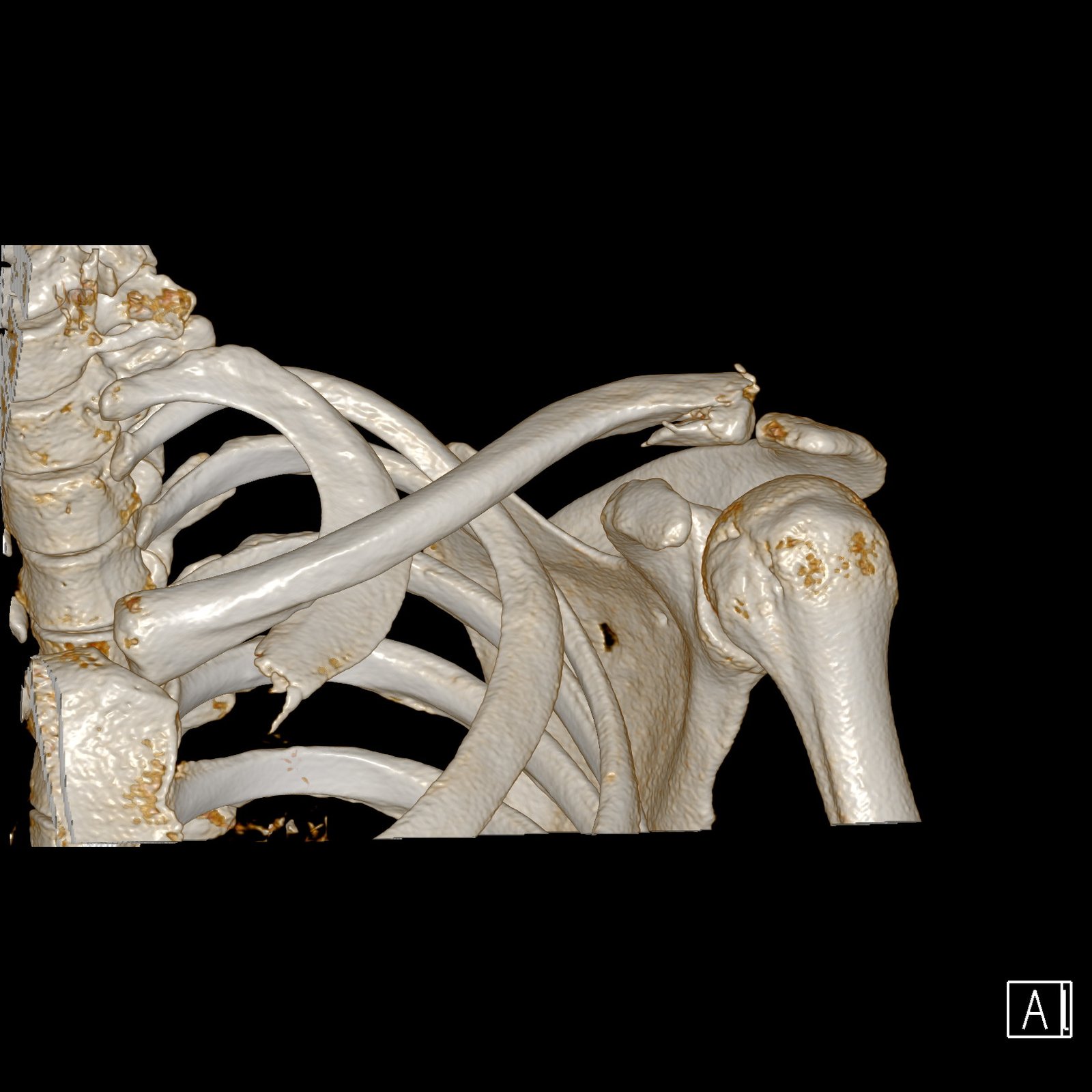 3D-CT-beeld van een breuk aan het buitenste deel van het sleutelbeen