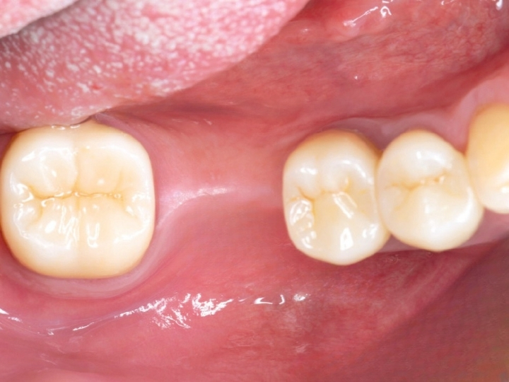 How a Dental Implant Replaces a Missing Back Tooth: A Step-By-Step Guide