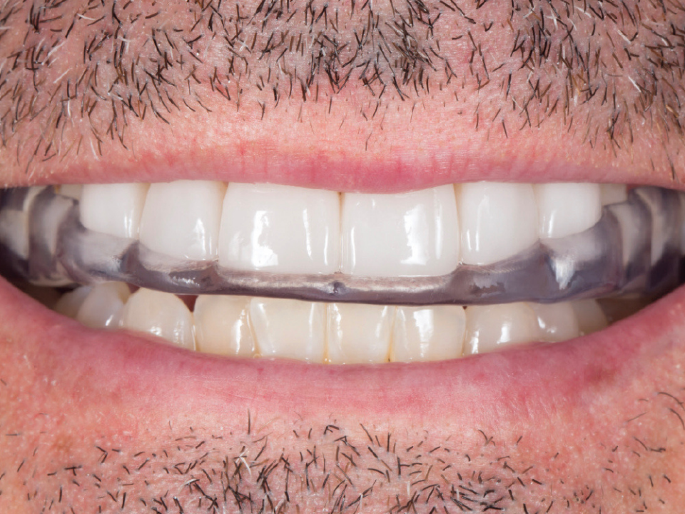 Nightguards for Veneers: Why They Matter, Who Needs Them, and How Retainers Fit In