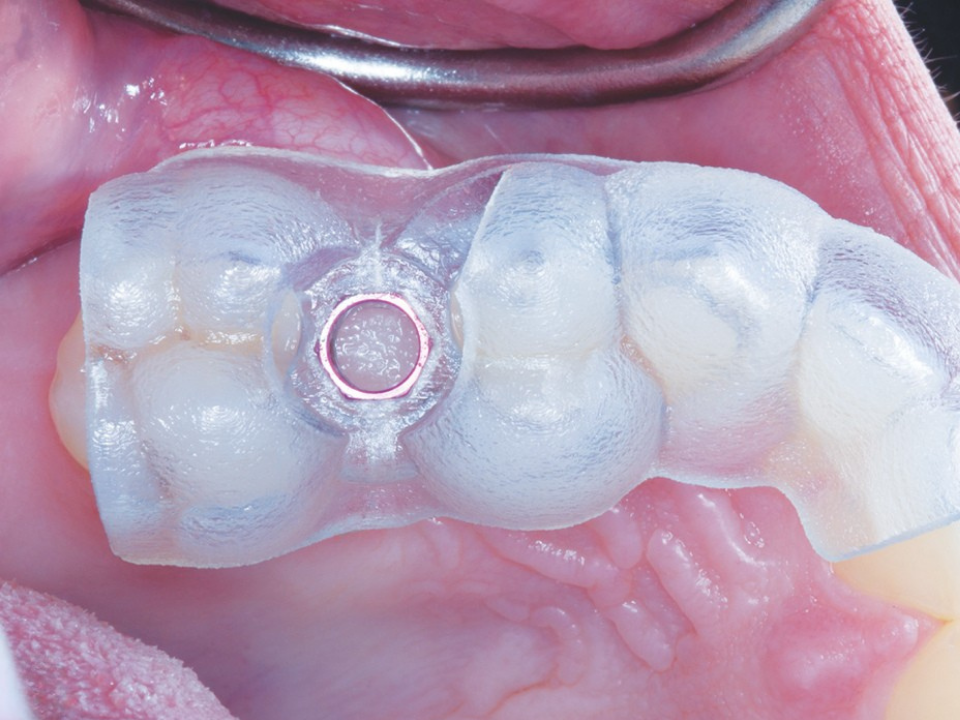 Guided Implant Surgery: How Digital Planning Creates Perfect Implant Placement, Every Time