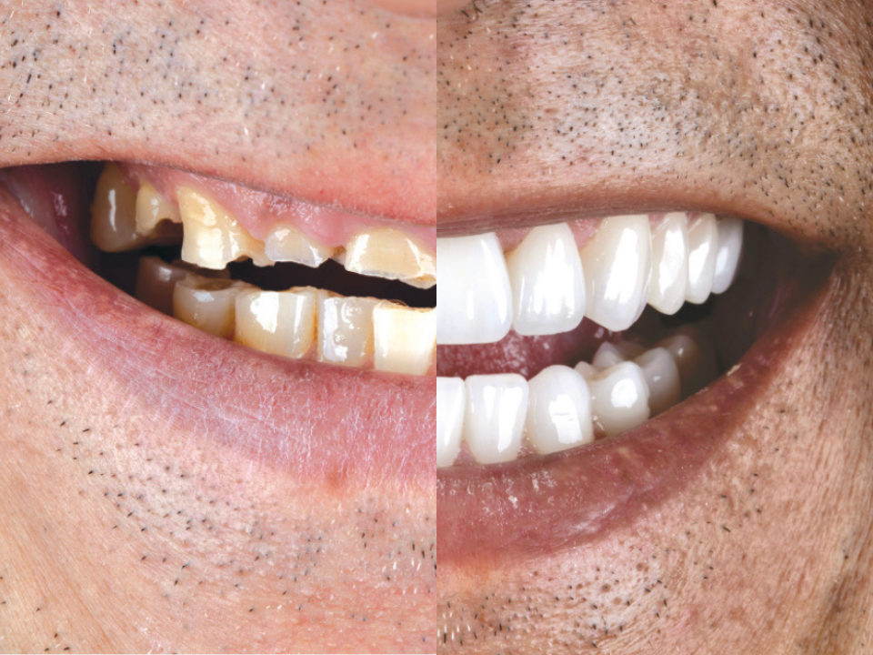 Full Mouth Reconstruction: Restoring Function, Health & Confidence When a Smile Has Fully Broken Down